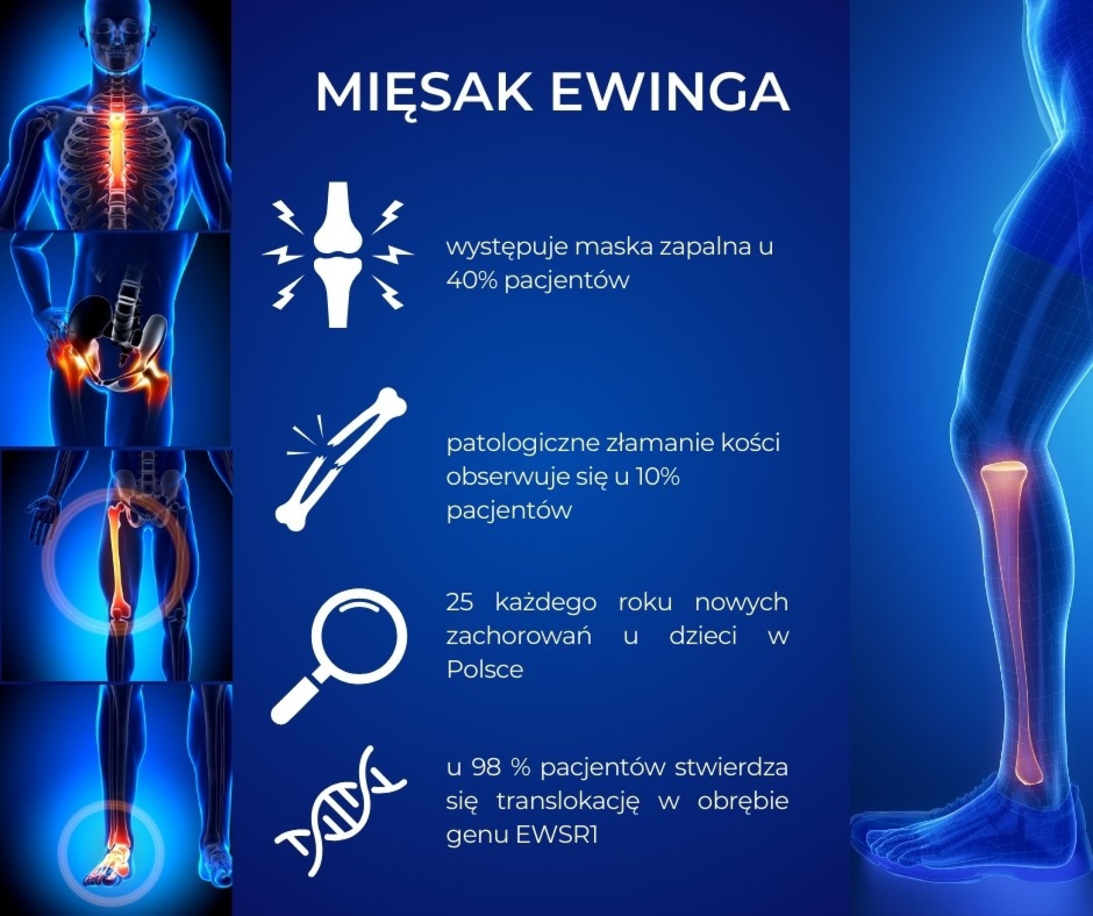 mięsak ewinga - leczenie